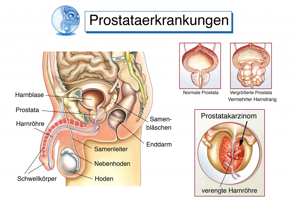 Prostataerkrankungen können für Blut im Urin verantwortlich sein.