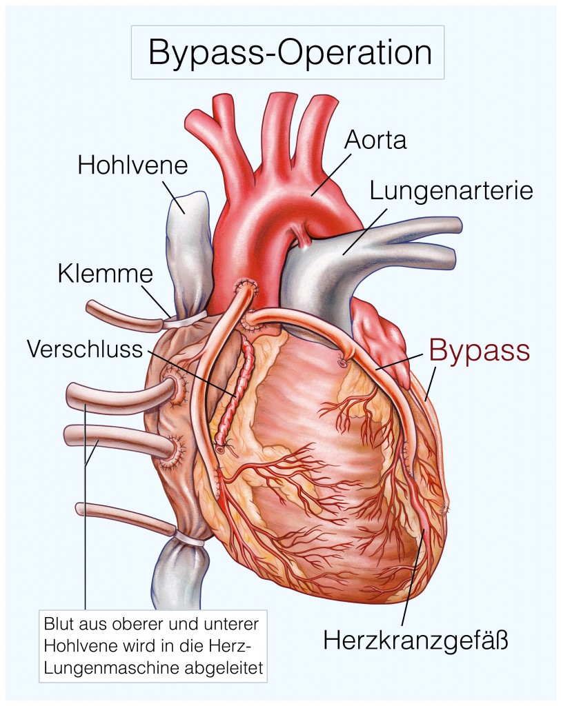 Das ist das Ziel einer By-Pass-Operation. (Bild: Henrie/fotolia)