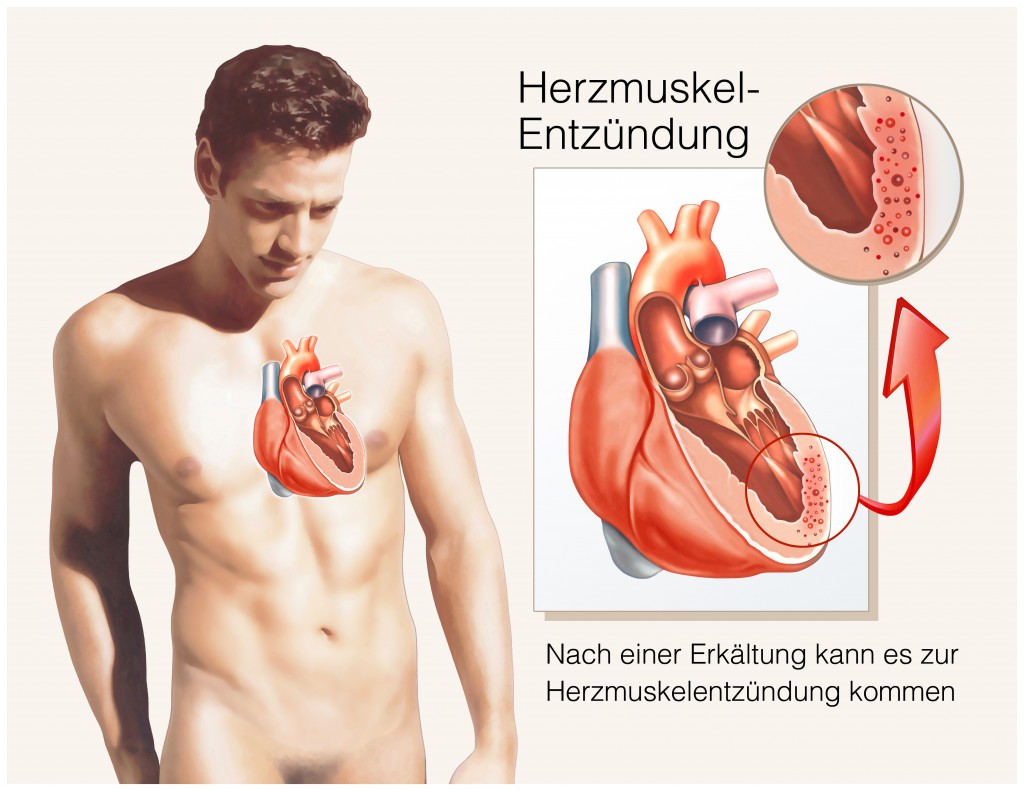 Möglich ist aber auch eine Herzmuskelentzündung. Vor allem dann, wenn Kreislaufprobleme hinzu kommen. Im Zweifel immer einen Arzt konsultieren.