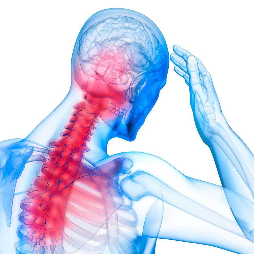 Schmerzlokalisation beim akuten HWS-Syndrom. Bild: psdesign1 - fotolia