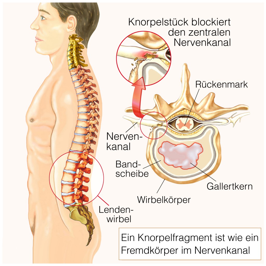 Die Manualtherapie der Osteochondrose der Wirbelsäule