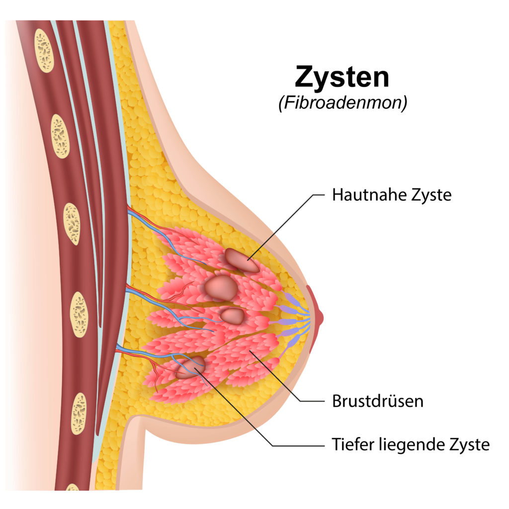 Wem hat lewomekol bei der Hämorrhoide die Rezensionen geholfen