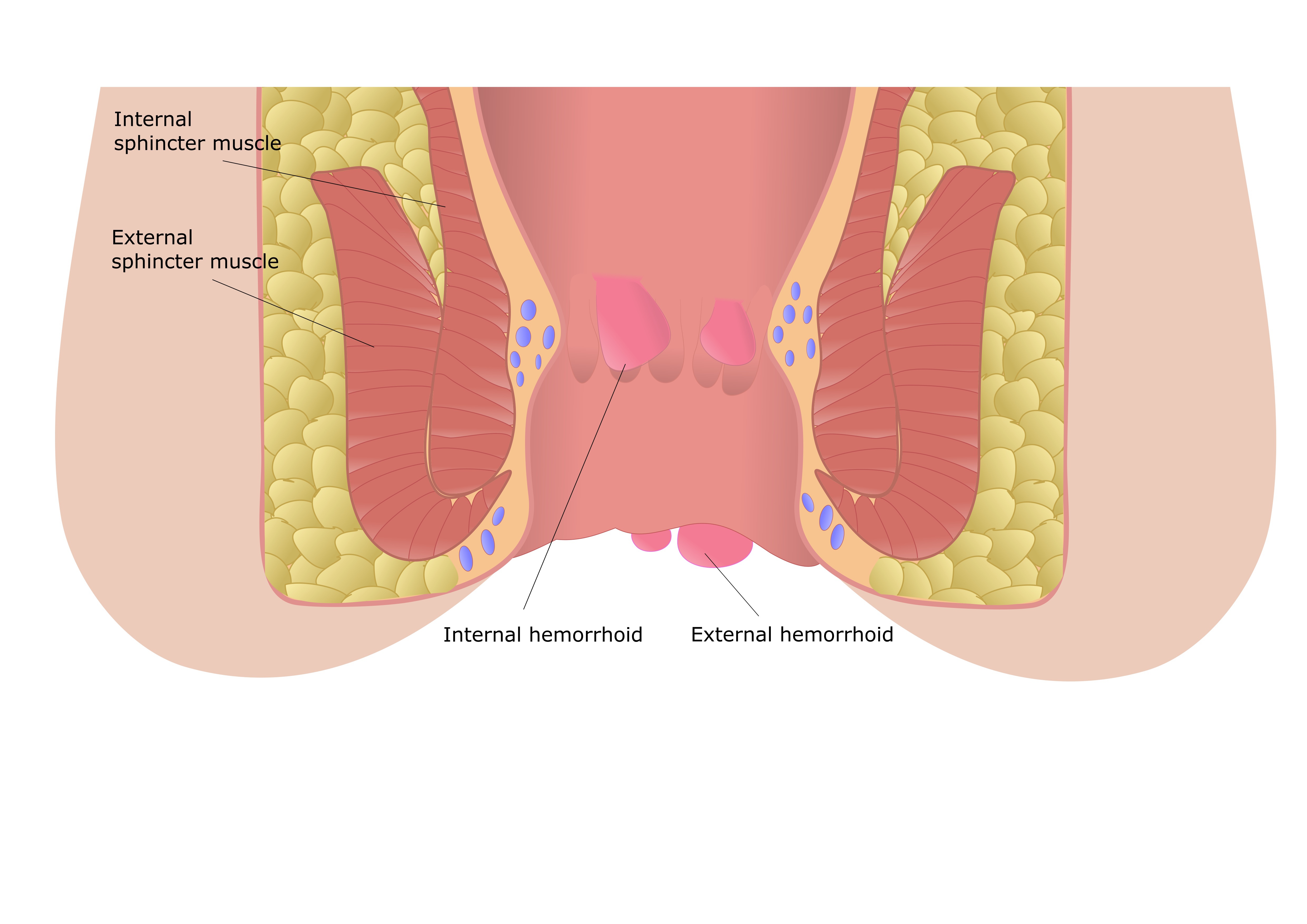 Die moderne Weise der Abtragung der Hämorrhoide