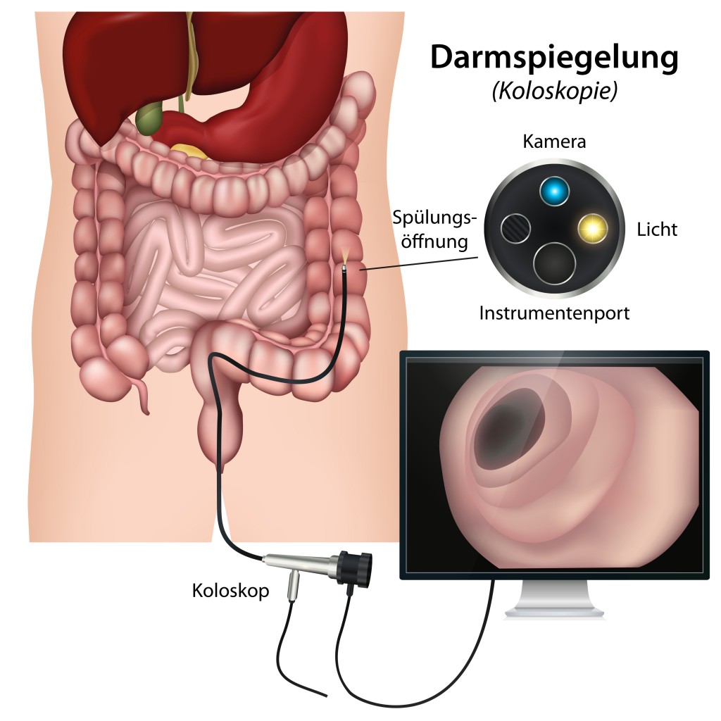 Divertikel werden häufig per Darmspiegelung entdeckt. Bild: Bilderzwerg-fotolia
