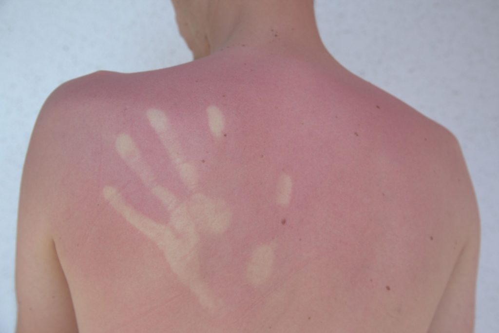 Krebsgefahr SonnenbrandTattoos gefährden die Gesundheit