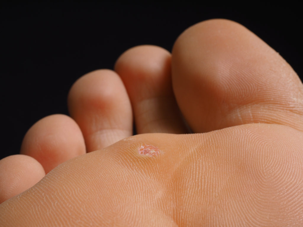 Warts : Types, Treatments, Causes - WebMD