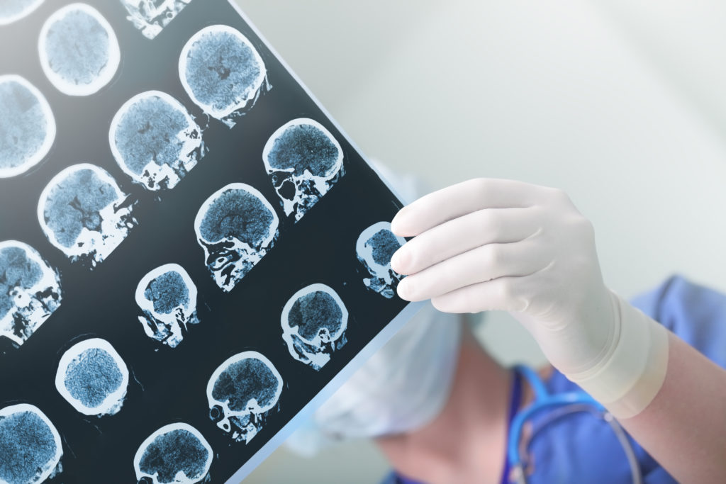 Mediziner planen die erste Kopftransplantation weltweit für das Jahr 2017. (Bild: sudok1/fotolia.com)