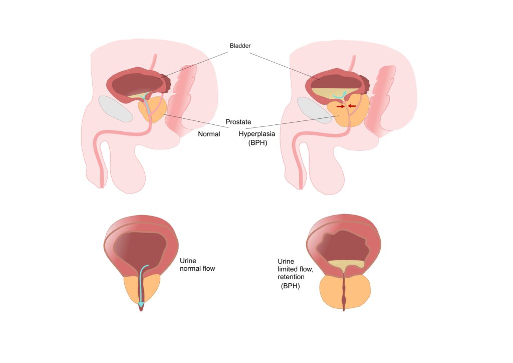 Studie: Sport senkt das Prostatakrebs-Sterberisiko!