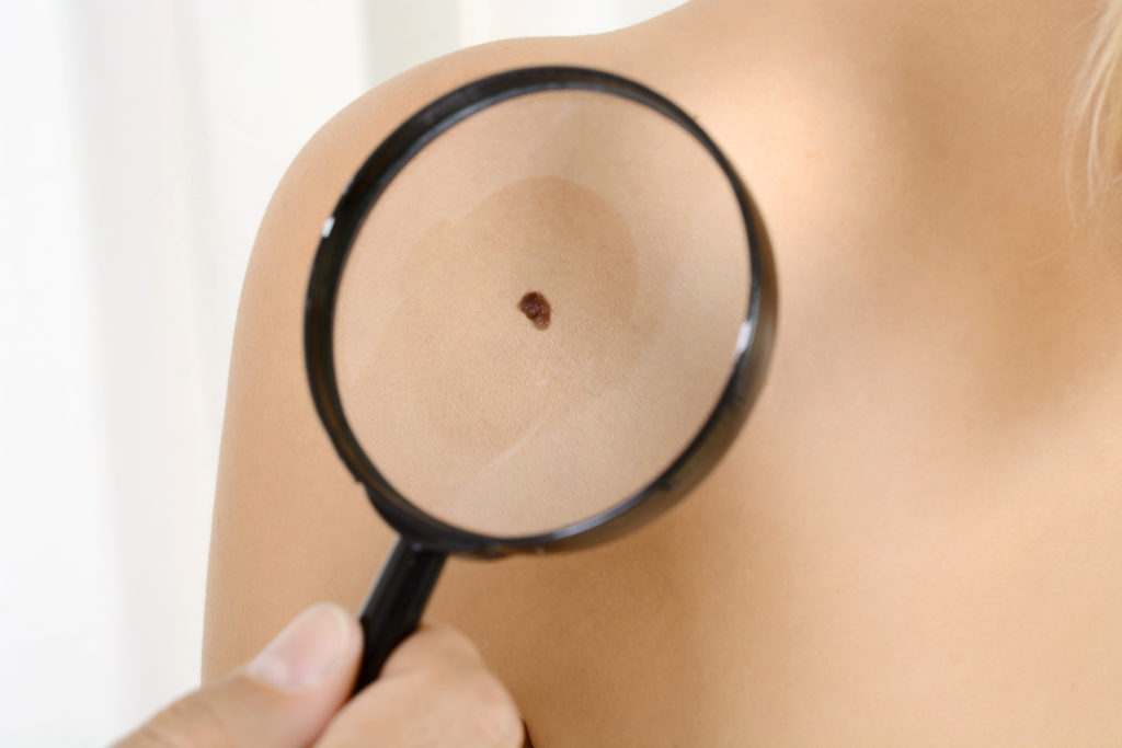 Eine spezielle microRNA kann die Invasionsfähigkeit von schwarzem Hautrebs deutlich reduzieren. (Bild: Dan Race/fotolia.com)