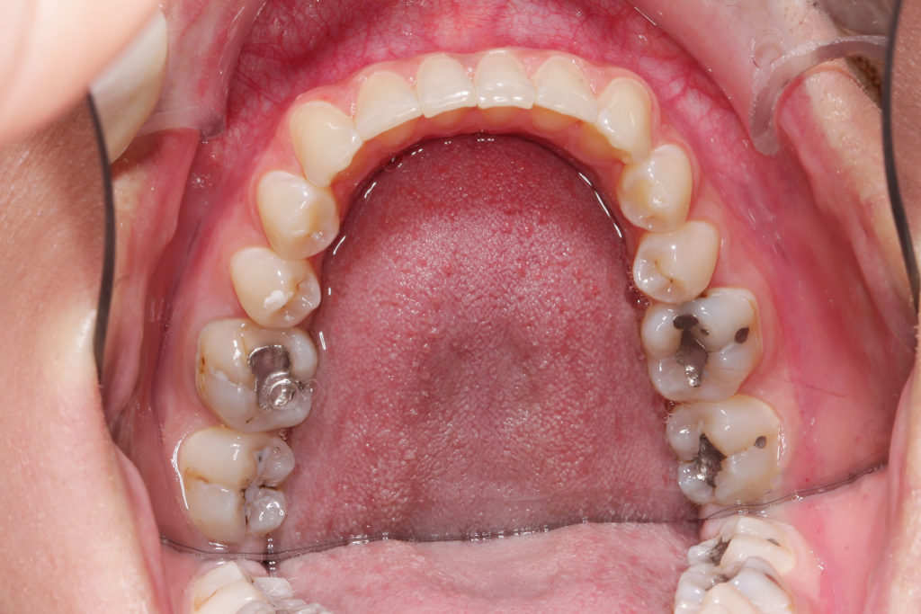 Doch kein Schmerzensgeld wegen Amalgam-Füllungen. Bild: artepicturas - fotolia