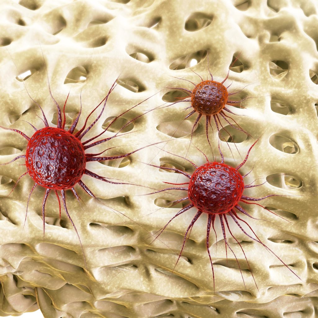 Häufig bilden sich bei Krebserkrankungen Knochenmetastasen, die eine Schwächung der Knochenstruktur zur Folge haben. (Bild: fotoliaxrender/fotolia.com)