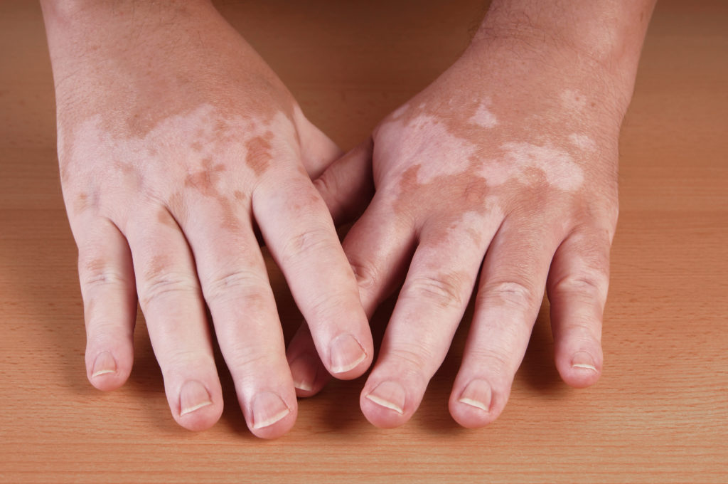 Bei der Weißfleckenkrankheit greift das Immunsystem die Pigmentzellen der Haut an. Natürliche Killerzellen spielen hierbei eine entscheidende Rolle. (Bild: Axel Bueckert/fotolia.com)