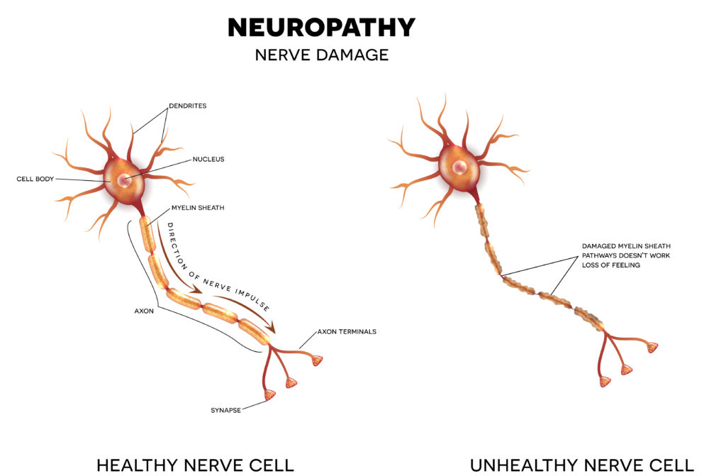 Chronische Schmerzen in Form einer Neuropathie können mit Hilfe der rückenmarksnahen Elektrostimulation therapiert werden. (Bild: reineg/fotolia.com)