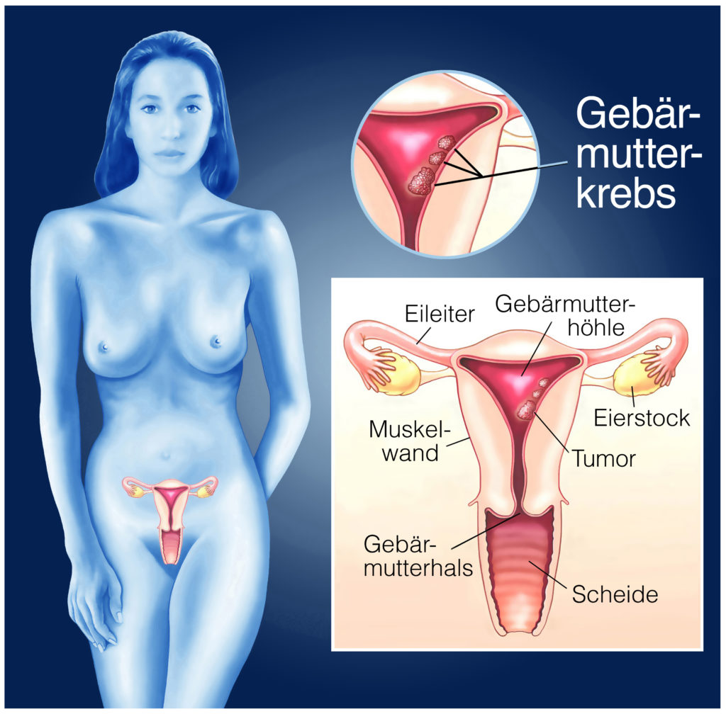 Frauen mit einer sogenannten BRAC1-Mutation sollten besonders vorsichtig sein. Forscher fanden heraus, dass diese Frauen ein erhöhtes Risiko für eine tödliche Form von Gebärmutterkrebs haben. (Bild: Henrie/fotolia.com)