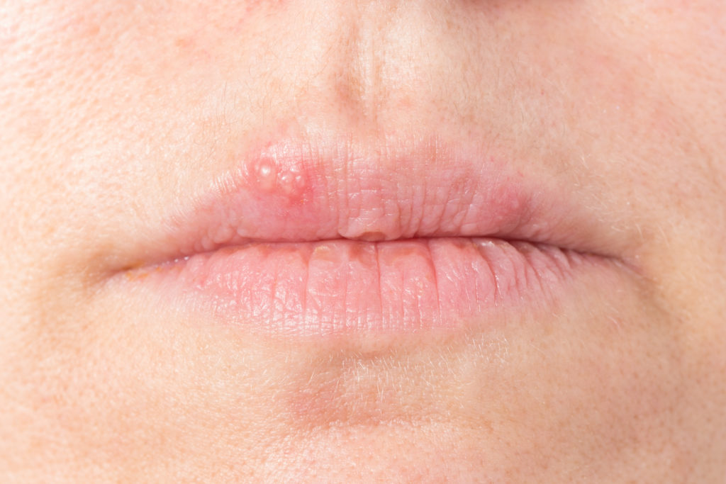 Gegen Lippenbläschen kann mit zahlreichen Hausmitteln vorgegangen werden, wobei sowohl eine innerliche als auch eine äußerliche Anwendung möglich ist. (Bild: bmf-foto.de/fotolia.com)
