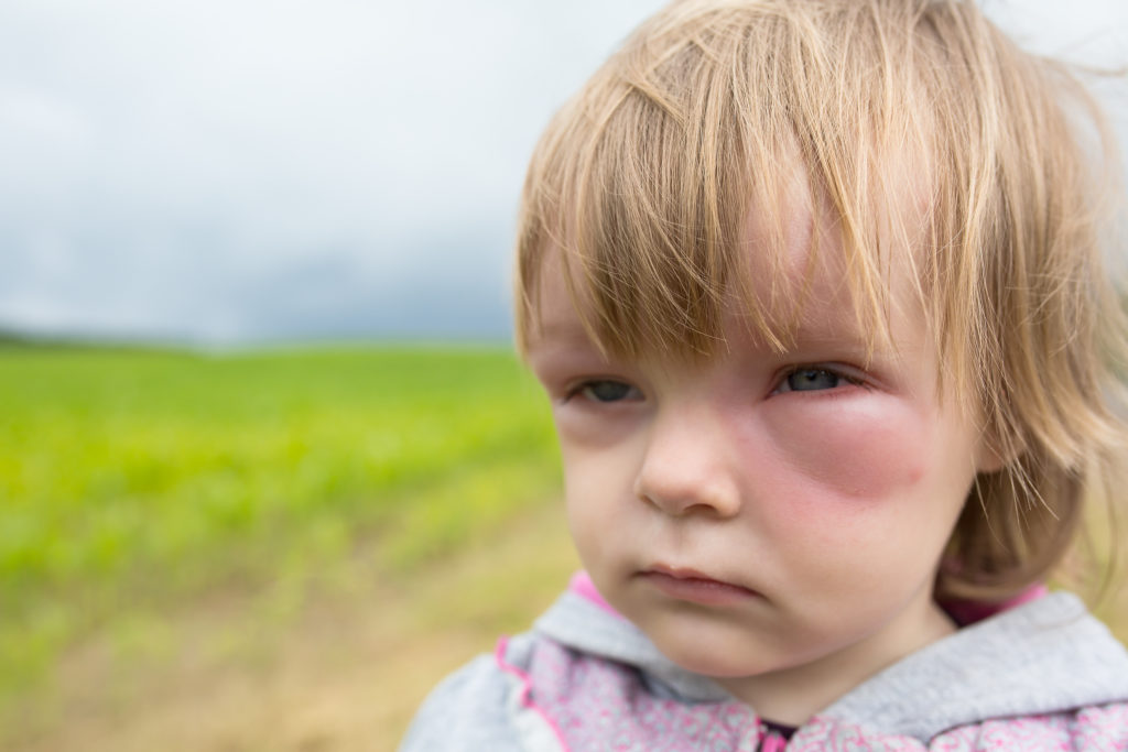 Die Krankheit lässt sich leicht mit einer Allergie verwechseln
