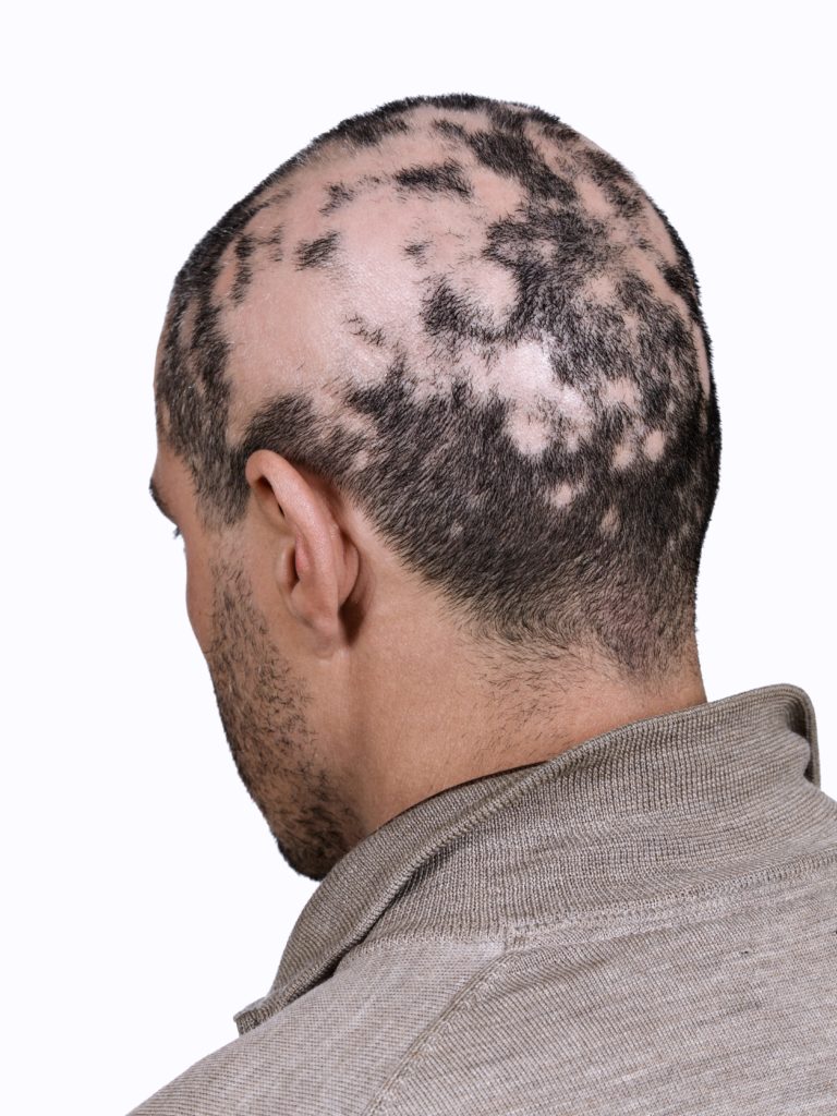 Alopecia Areata Frau - Alopecia Areata e.V. Deutschland Gruppe Berlin - Alopecia areata is an autoimmune disorder that causes your hair to come out, often in clumps the alopecia areata can't be cured.