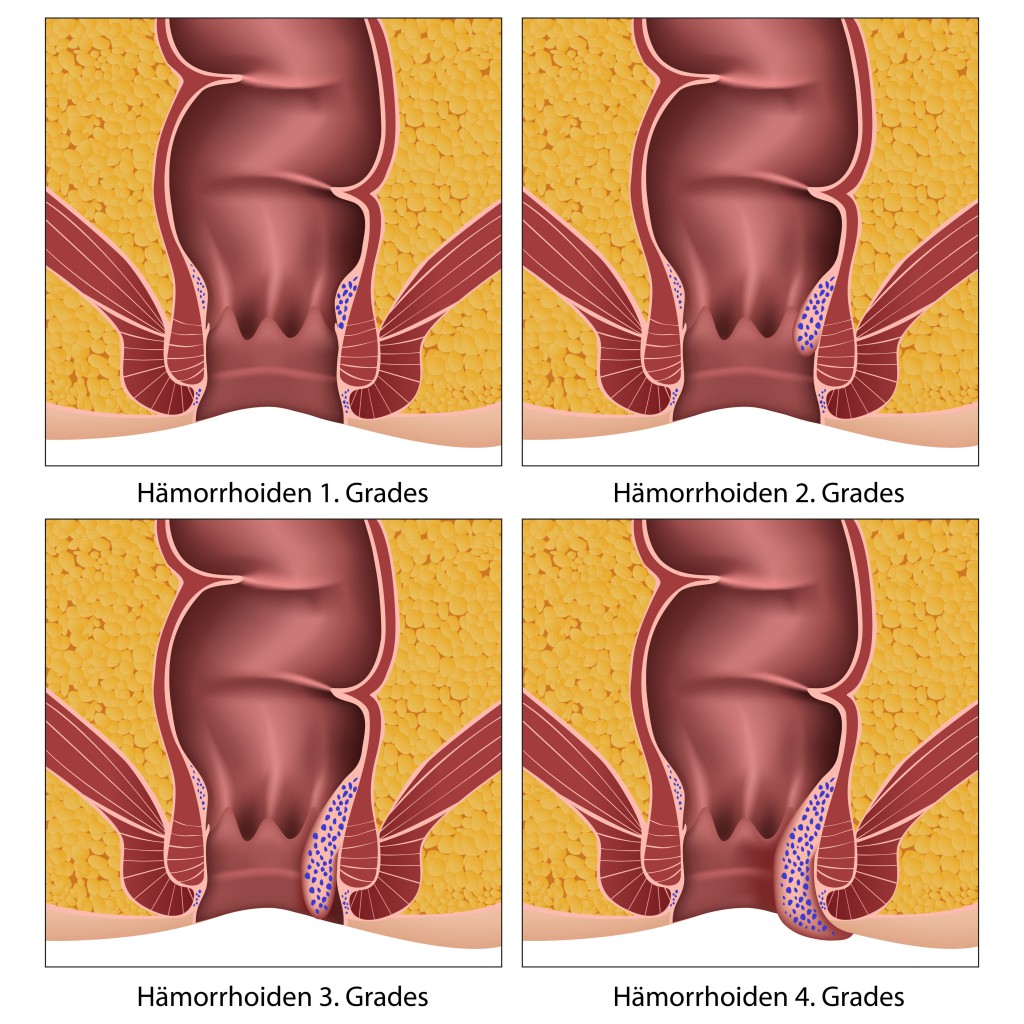 Hmorrhoiden Erkrankungsgrade