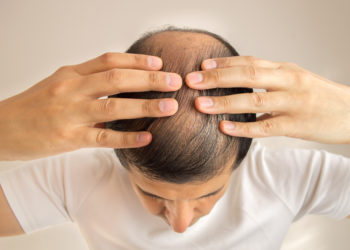Diffuser Haarausfall hat vielfältige Ursachen, die von Krankheiten über Stress bis hin zu Nebenwirkungen bestimmter Medikamente reichen. (Bild: cunaplus/fotolia.com)