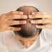 Diffuser Haarausfall hat vielfältige Ursachen, die von Krankheiten über Stress bis hin zu Nebenwirkungen bestimmter Medikamente reichen. (Bild: cunaplus/fotolia.com)