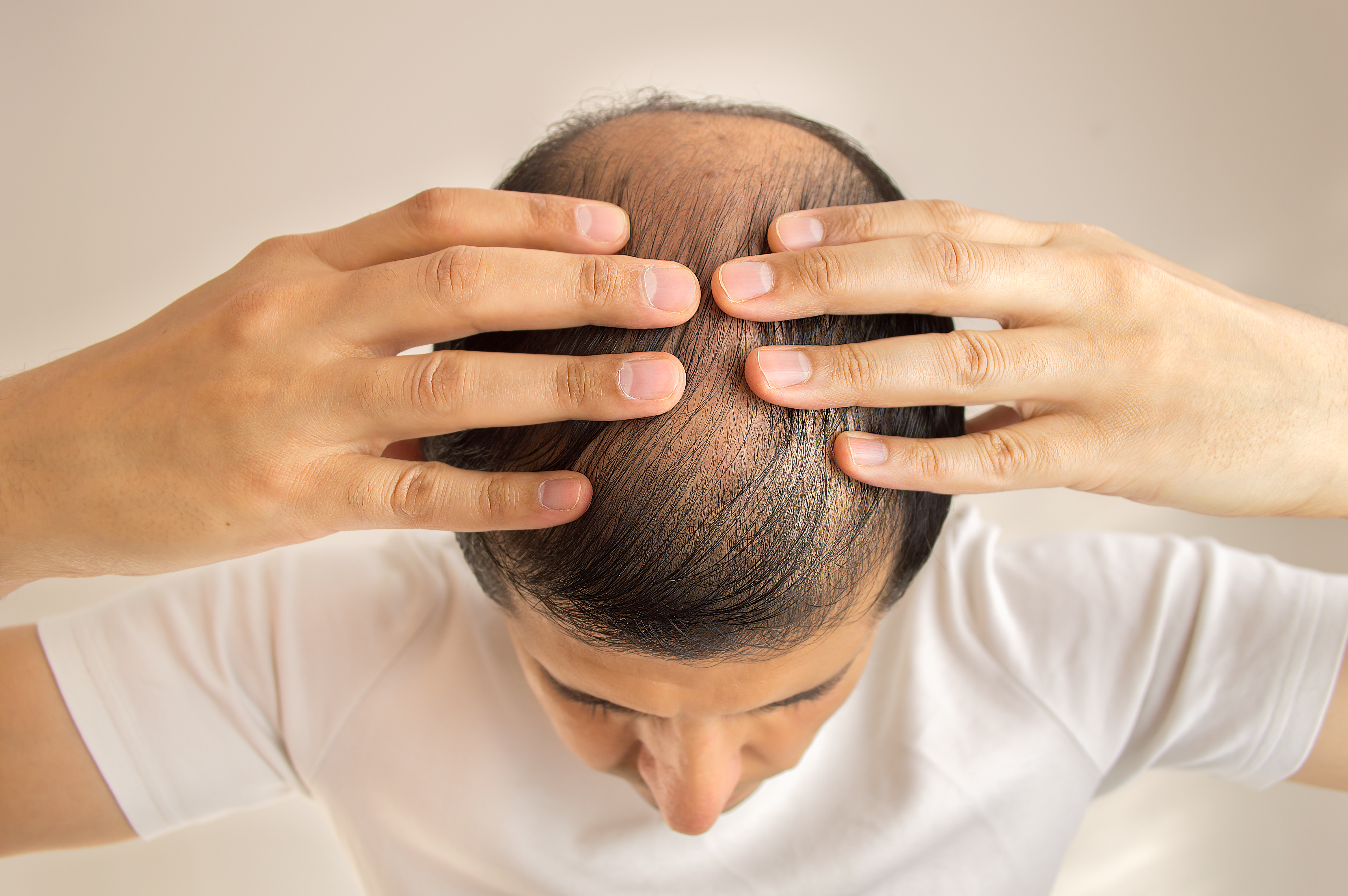Выпадение волос у мужчин лечение. Редеющие волосы у мужчин.