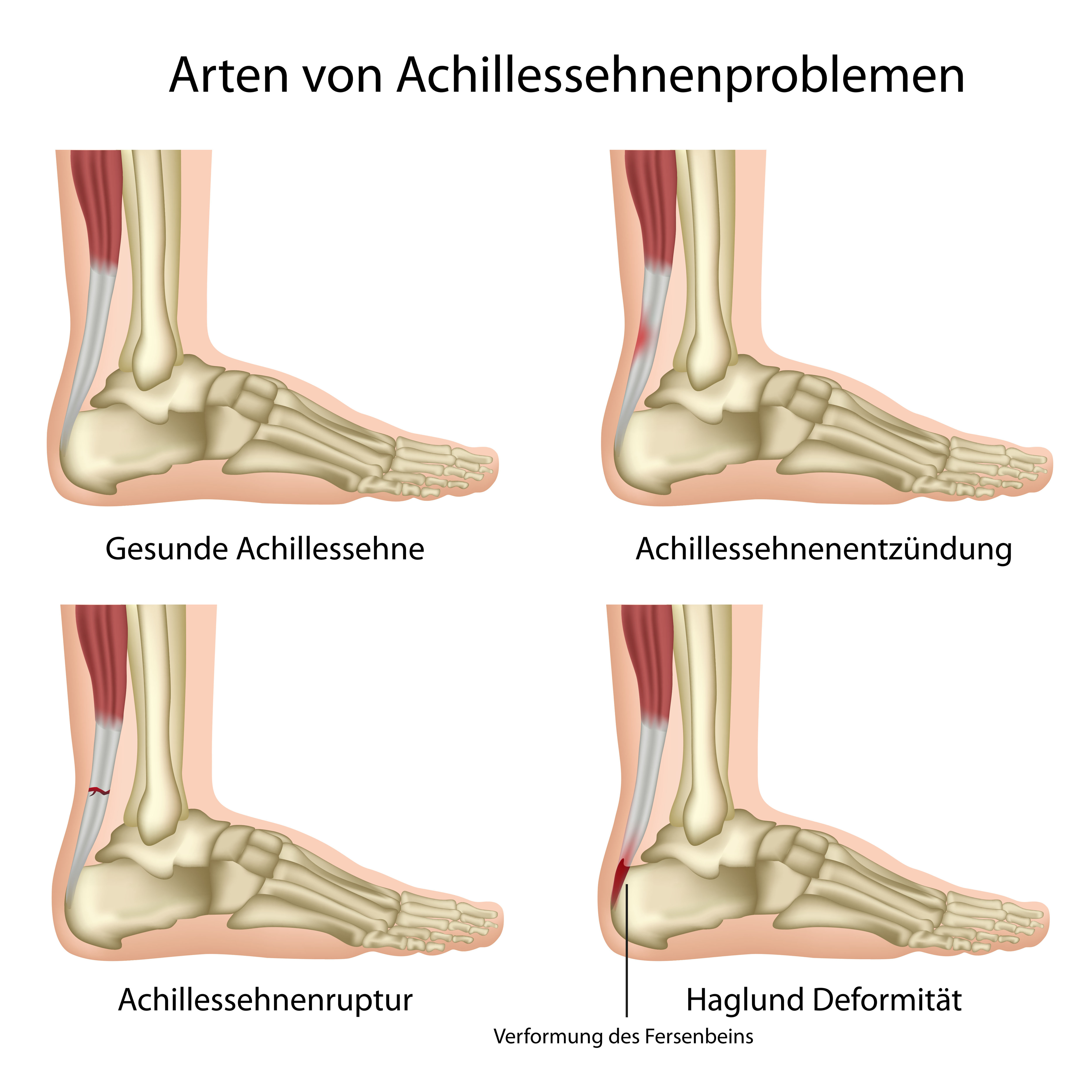 Schmerzen der Achillessehne kÃ¶nnen verschiedene Ursachen haben. 