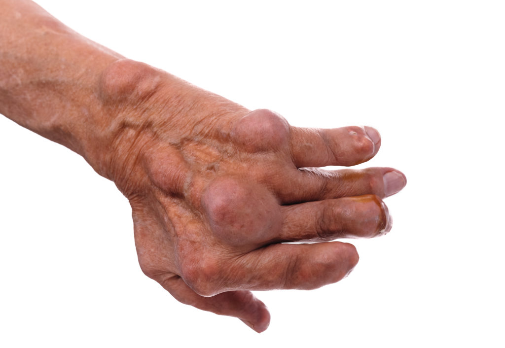  Die Gelenkentzündungen bei der chronischen Polyarthritis können langfristig erhebliche Deformierungen der Gelenke bedingen. (Bild: ivandanru/fotolia.com)