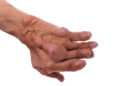 Die Gelenkentzündungen bei der chronischen Polyarthritis können langfristig erhebliche Deformierungen der Gelenke bedingen. (Bild: ivandanru/fotolia.com)