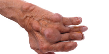 Die Gelenkentzündungen bei der chronischen Polyarthritis können langfristig erhebliche Deformierungen der Gelenke bedingen. (Bild: ivandanru/fotolia.com)