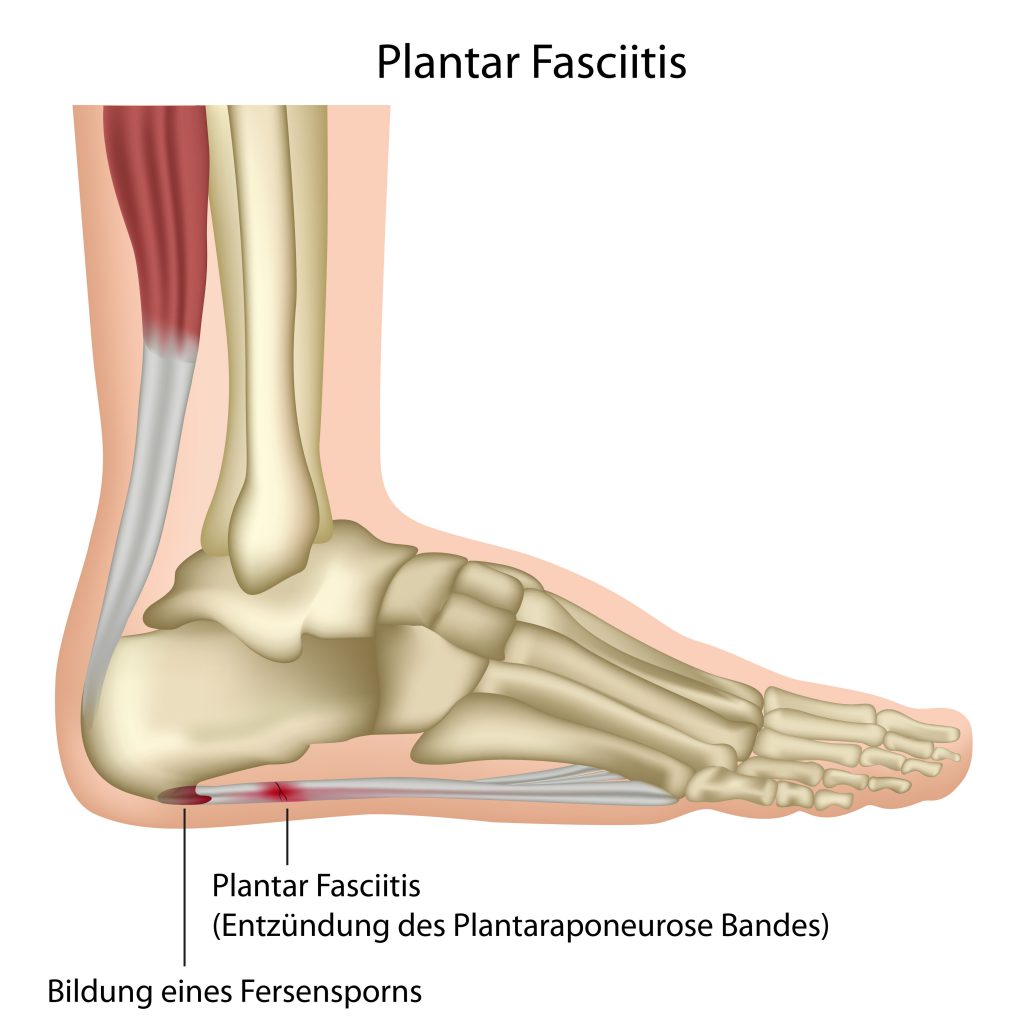 Oft ist ein unterer Fersensporn mit einer Entzündung der Sehenllatte (Plantarfasziitis) unter dem Fuß verbunden. (Bild bilderzwergfotolia.com)