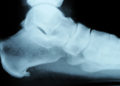 Ein Fersensporn kann sowohl am Sehnenansatz unter dem Fuß (wie auf dem Bild) als auch am oberen Sehnenansatz des Fersenbeins entstehen. (Bild: Whyona/fotolia.com)