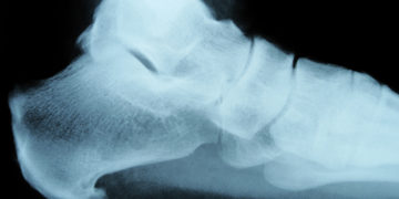 Ein Fersensporn kann sowohl am Sehnenansatz unter dem Fuß (wie auf dem Bild) als auch am oberen Sehnenansatz des Fersenbeins entstehen. (Bild: Whyona/fotolia.com)