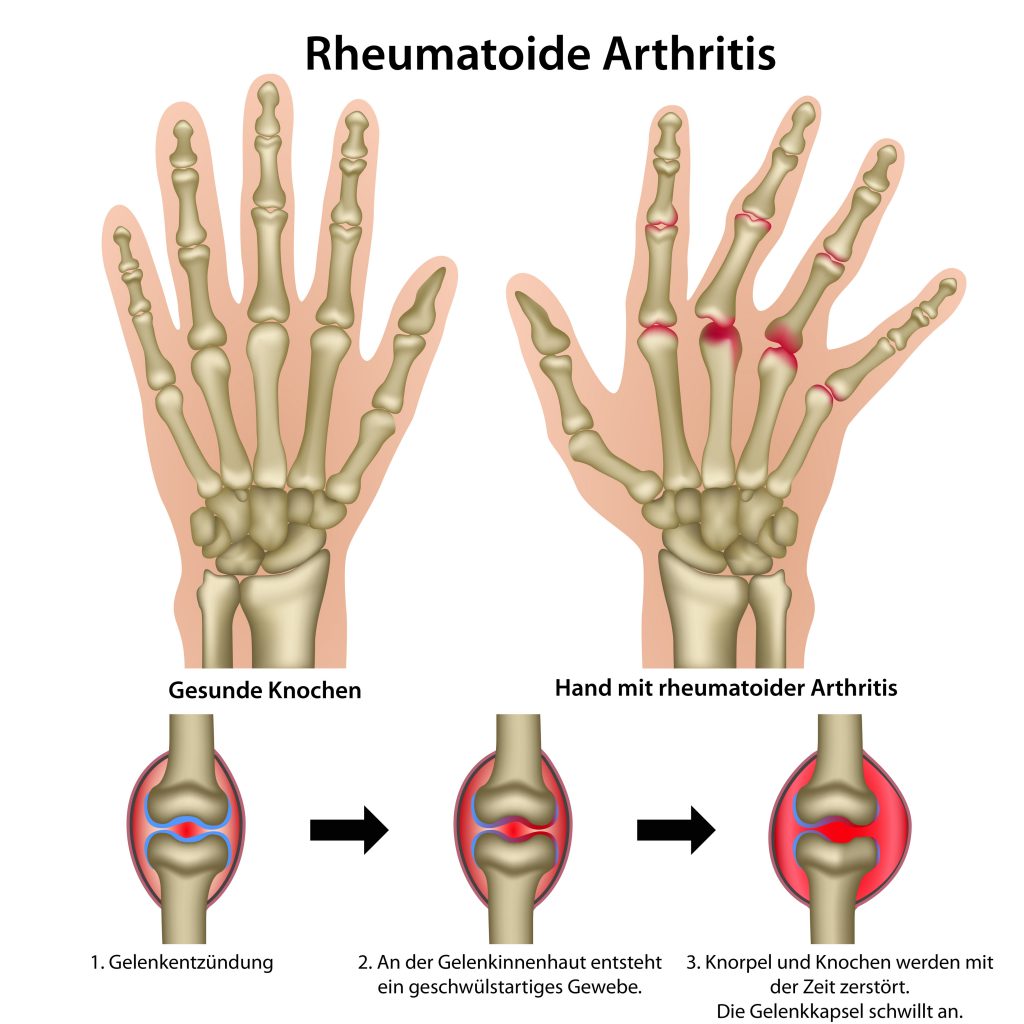 Eine Wucherung der Gelenkinnenhaut bedingt die krankhaften Veränderungen der Gelenkstrukturen bei der chronischen Polyarthritis. (Bild: bilderzwerg/fotolia.com)