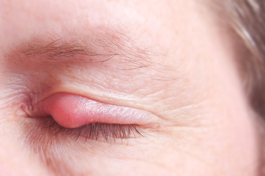 Ein Gerstenkorn ist für die Betroffenen äußerst unangenehm, heilt jedoch in der Regel nach rund einer Woche von alleine wieder ab. (Bild: Heiko Barth/fotolia.com)