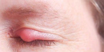 Ein Gerstenkorn ist für die Betroffenen äußerst unangenehm, heilt jedoch in der Regel nach rund einer Woche von alleine wieder ab. (Bild: Heiko Barth/fotolia.com)