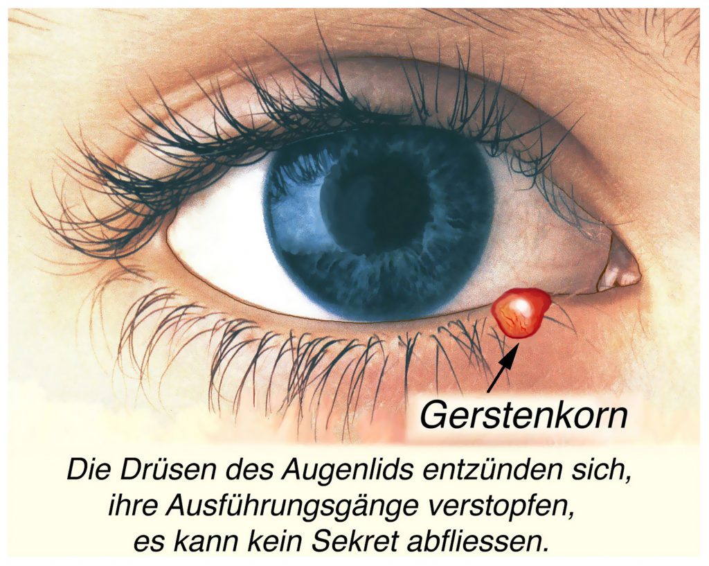 Ursache des Gerstenkorns ist die bakterielle Infektion einer Drüse am Augenlid mit entsprechender Entzündung. (Bild: Henrie/fotolia.com)