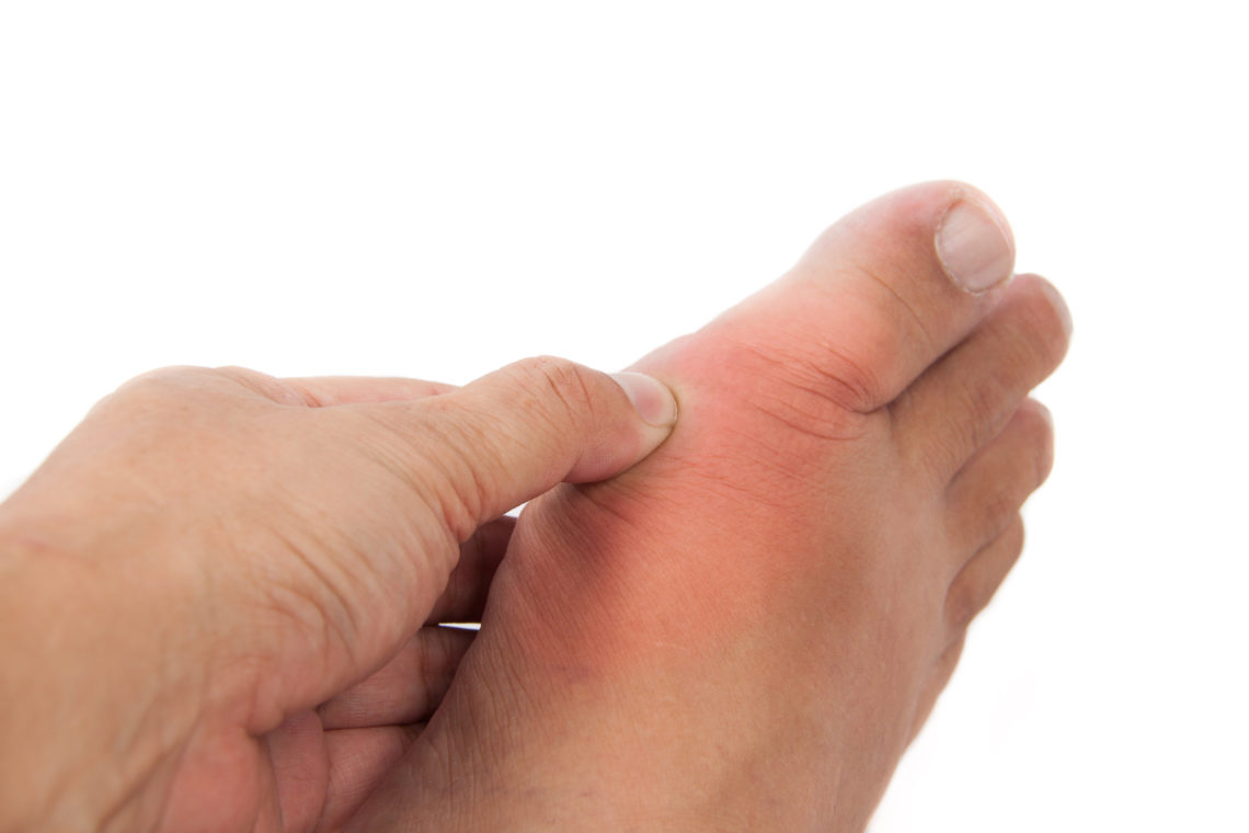 Gicht Symptome und Therapie Heilpraxis