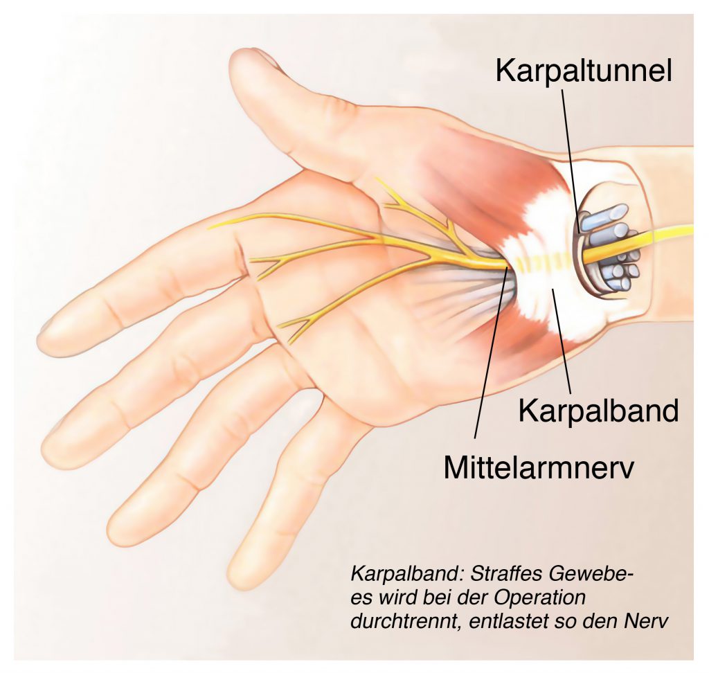 In dem relativ engen Karpaltunnel kann leicht eine Kompression des Nervs auftreten, die ein Absterben der Nervenzellen und entsrepchende Folgebeschwerden bedingt. Eine Operation ist hier unter Umständen unerlässlich. (Bild: Henrie/fotolia.com)