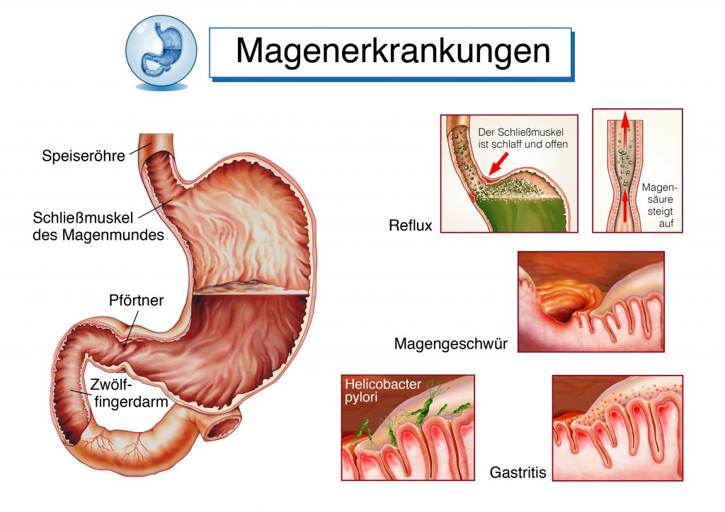 Ein Reflux kann Ursache wiederholter Kehlkopfentzündungen sein, da die Schleimhaut durch die augestoßene Magensäure gereizt wird. (Bild: Henrie/fotolia.com)