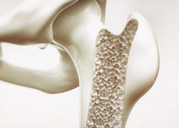 Bei der Osteoporose verlieren die Knochen ihre Festigkeit und brechen dadurch leichter. (Bild: crevis/fotolia.com)
