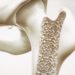 Bei der Osteoporose verlieren die Knochen ihre Festigkeit und brechen dadurch leichter. (Bild: crevis/fotolia.com)