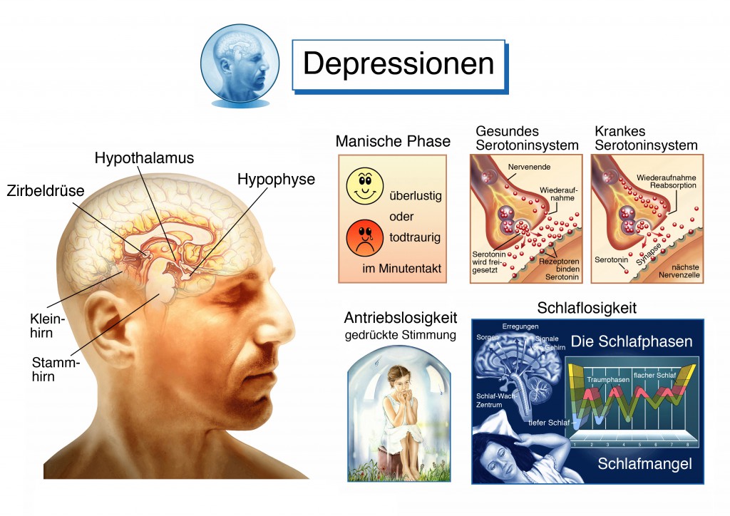Bei einer Depression kann es sein, dass es zu Unterfunktionen im Gehirn kommen kann. (Bild: Henrie/fotolia)