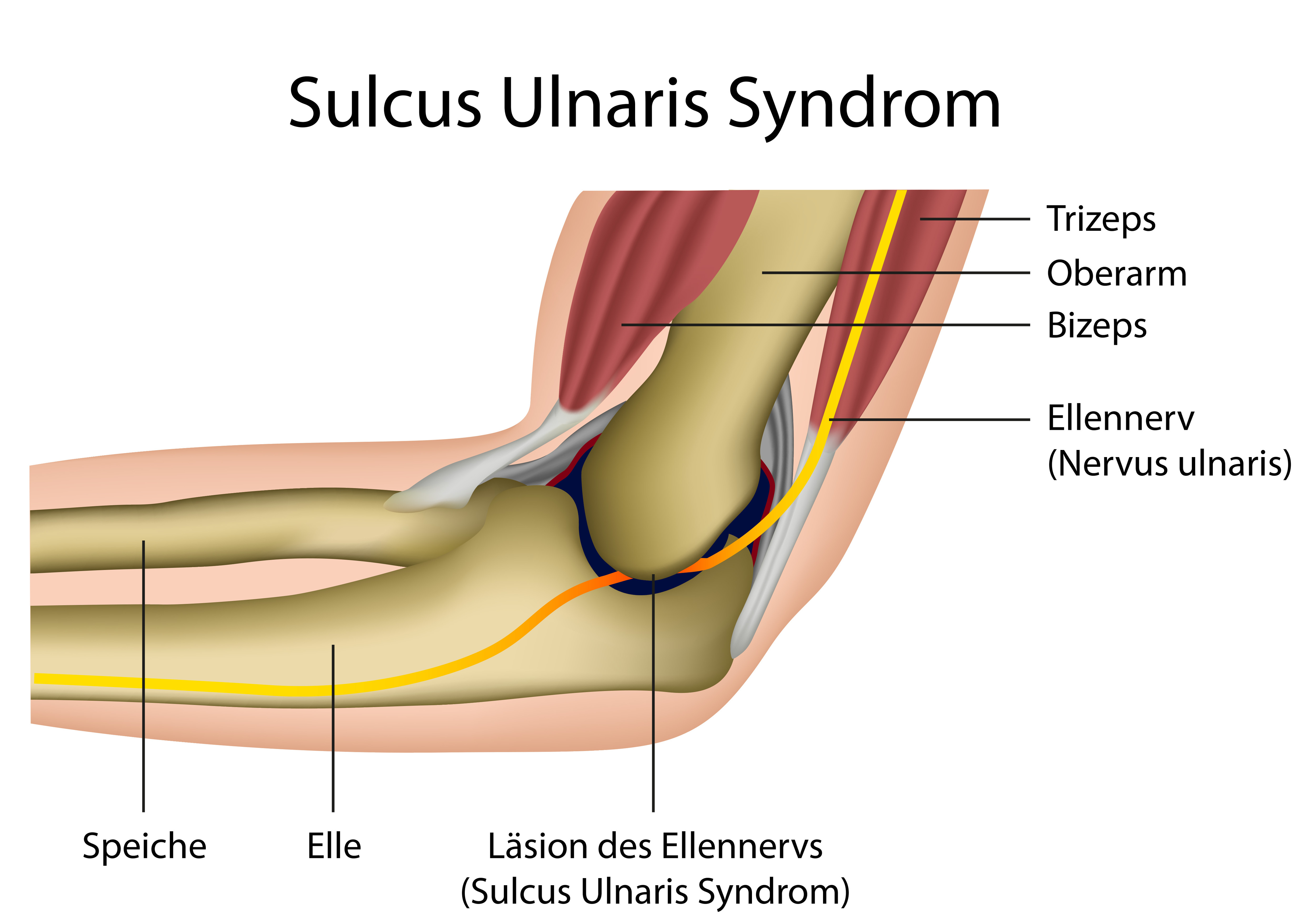 Sulcus ulnaris- oder Kubitaltunnelsyndrom.