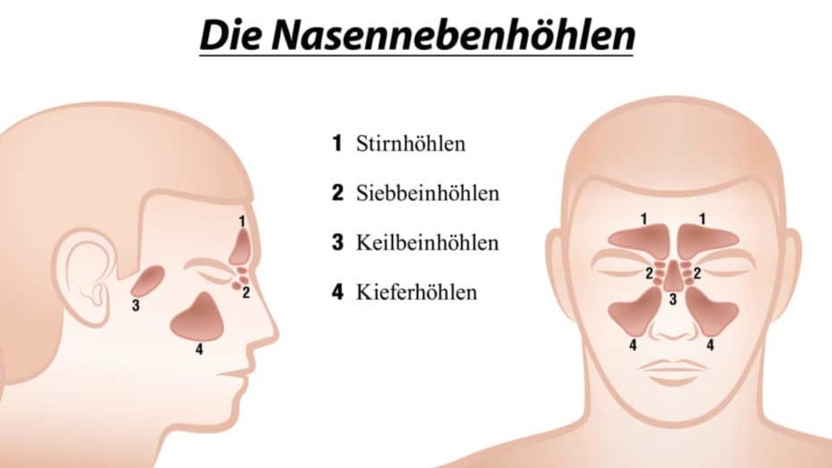 Nebenhohlenentzundung Diese Hausmittel Konnen Helfen