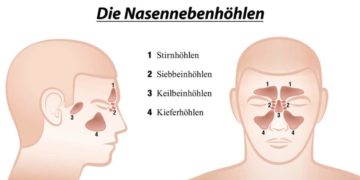 Es wird zwischen vier verschiedenen Nasennebenhöhlen unterschieden, die offen mit dem mittleren Nasengang verbunden sind. (Bild: Peter Hermes Furian/fotolia.com)