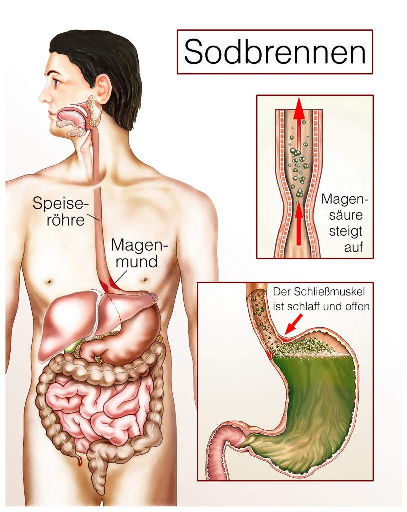 Sodbrennen Ursachen