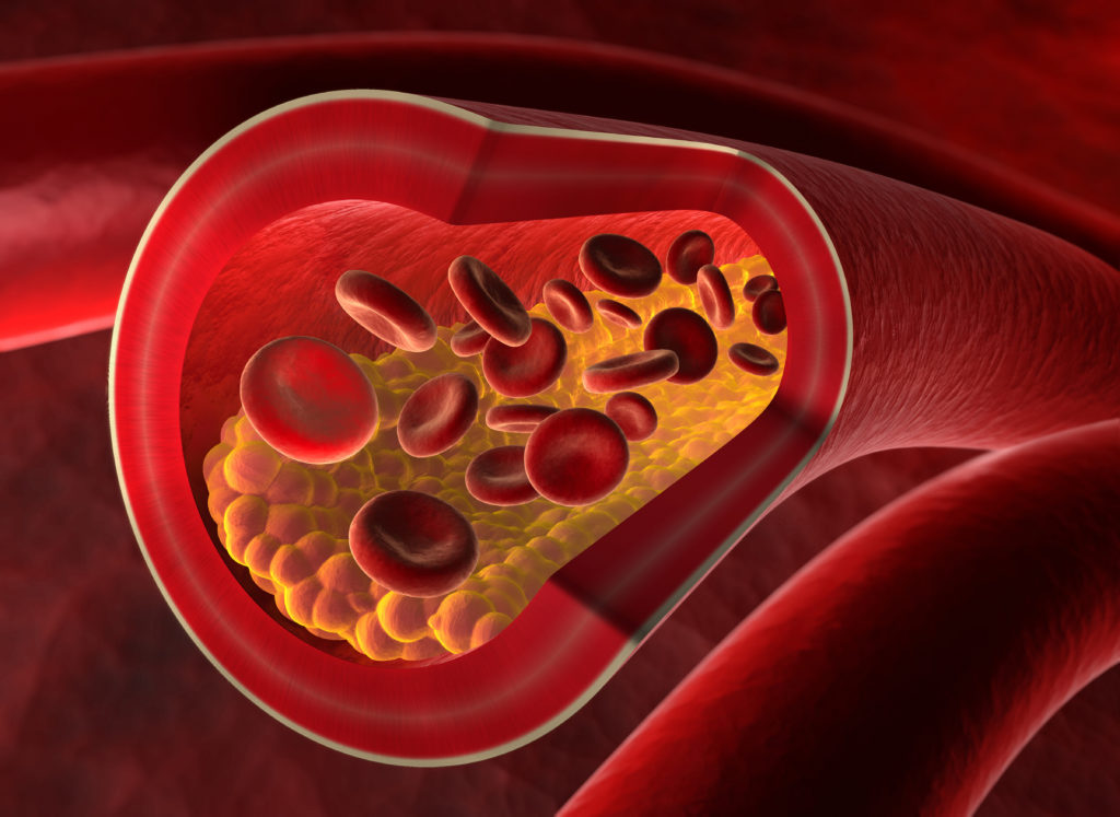 Arterienverkalkung ist eine Hauptursache für einen Herzinfarkt. 