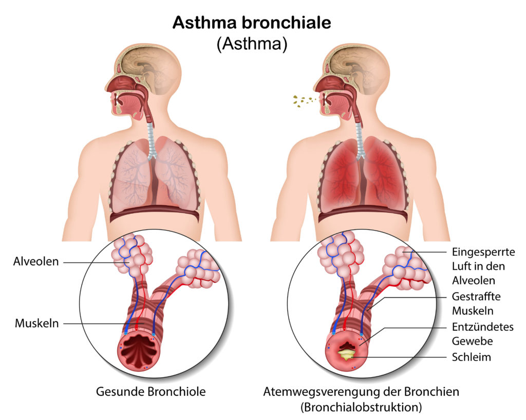 Wie Asthma ensteht