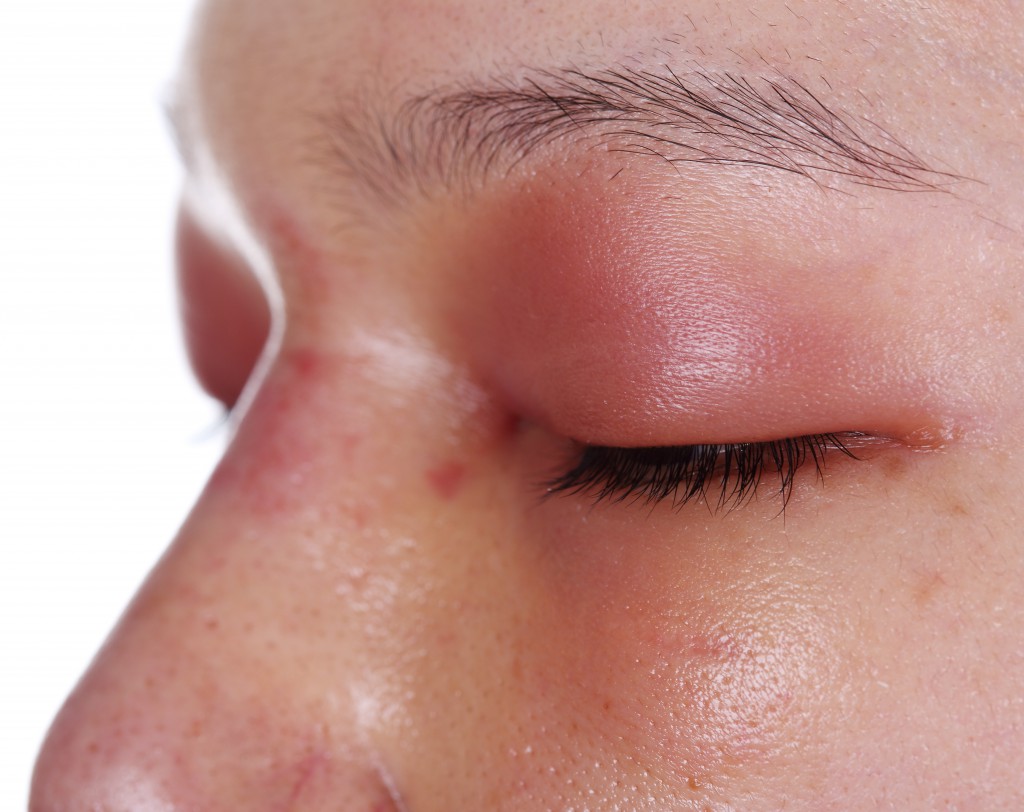 close-up of upper eye lid swell after nose job plastic surgery