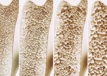 Osteoporose ist weltweit die häufigste Knochenerkrankung. Hierzulande sind über sechs Millionen Menschen betroffen. Und es werden mehr. Doch es gibt Möglichkeiten, der Krankheit vorzubeugen. (Bild: crevis/fotolia.com)